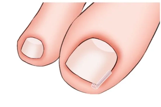 Paski na wrastające paznokcie 10 szt.